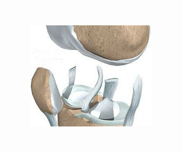 A SMART method to enhance effectiveness of cartilage repair therapy
