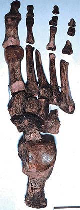Ultrasonic waves approved for broken bones
